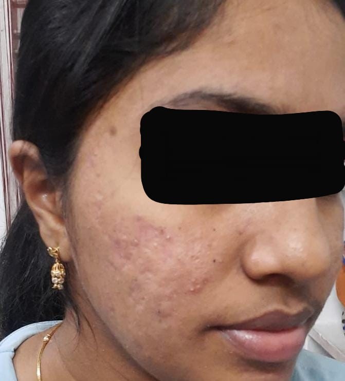 Acne Vulgaris 5